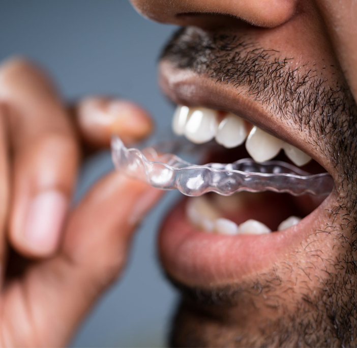 Orthodontics  Aligners